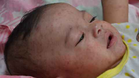 Az oltástagadó ügyvéd, aki halálos járványt okozott